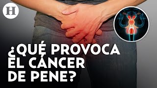 ¡Cáncer de pene si existe Urólogo te dice cuáles son las causas síntomas y tratamiento [upl. by Hayimas]