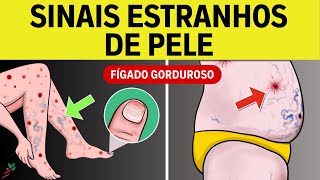 7 Sinais na Pele de Doenças do Fígado  Fígado Gorduroso  Cirrose Hepática [upl. by Leyla]