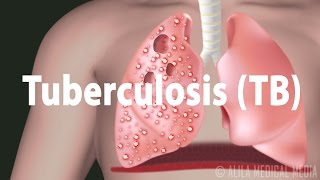 Tuberculosis TB Progression of the Disease Latent and Active Infections [upl. by Idurt100]