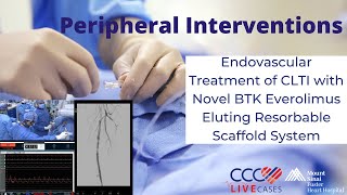 First Endovascular Treatment of CLTI with Novel BTK Everolimus Eluting Resorbable Scaffold System [upl. by Ilrac183]