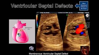 Fetal Echocardiography Ventricular Septal Defects [upl. by Fenwick]