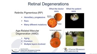 A Stem CellBased Therapy for Retinitis Pigmentosa [upl. by Adnohsel]