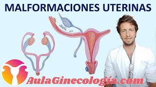 MALFORMACIONES UTERINAS bicorne septo arcuato didelfo agenesias  Ginecología y Obstetricia [upl. by Geldens81]