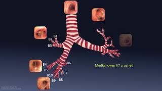 Mastering Bronchoscopy for Thoracic Surgery Chapter 1 [upl. by Vick]