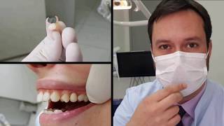 Dr Juliano Coura  O provisório perfeito para espera do Implante dentário [upl. by Talbert]