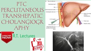 PTCPTHC PERCUTANEOUS TRANSHEPATIC CHOLANGIOGRAPHY Procedure HindiEnglish for BRT amp DRT students🥰 [upl. by Eggett803]