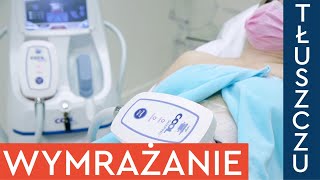 Jak działa kriolipoliza CoolShaping Pokazujemy zabieg wymrażania tłuszczu na brzuchu [upl. by Ahsikel]