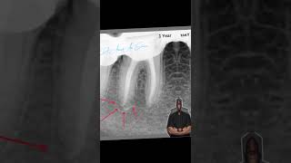 follow up1 year a case of acute periapical abcess الكربولة اكسبلور endodontics [upl. by Nodnas]