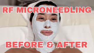 BUILDING COLLAGEN RF Microneedling Results [upl. by Mazonson288]