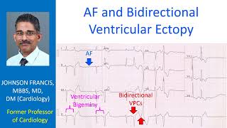 AF and Bidirectional Ventricular Ectopy [upl. by Hoxsie]