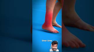 Sprained Ankle😱explained feet science didyouknow trendingshorts shots animation ai [upl. by Asilanom]