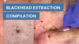 Extraction Satisfaction Blackhead Removal  CONTOUR DERMATOLOGY [upl. by Mill]