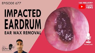 677  Impacted Eardrum Ear Wax Removal [upl. by Asusej]