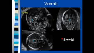 3D Ultrasound of Craniofacial Abnormalities [upl. by Anya]