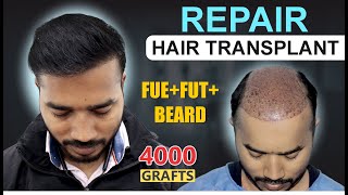 REPAIR Hair Transplant Results at Medispa Hair Transplant India  Best Cost  Best Result [upl. by Sucy]