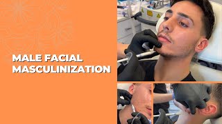 MALE FACIAL MASCULINIZATION WITH DERMAL FILLERS  Dr Jason Emer [upl. by Rattray]