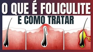 O que é Foliculite e como tratar [upl. by Jaqitsch]