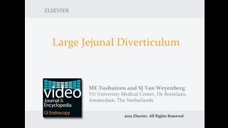 Large Jejunal Diverticulum [upl. by Selway]