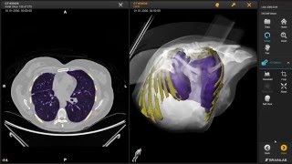 3D Slicer  Brainlab interoperability demonstration at RSNA 2015 [upl. by Adirem]