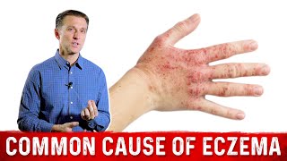 Is Your Eczema Coming from a Salicylate Sensitivity – Dr Berg On Atopic Dermatitis [upl. by Enyamert]