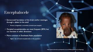 Anesthetic considerations Meningomyelocele Ecephalocele DandyWalker Comlex Chiari Malformations [upl. by Swords590]