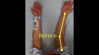 Elbow valgus deformitycubitus valgus surgery by Dr Ahn [upl. by Kapeed]