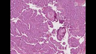 Histopathology Thyroid Papillary carcinoma [upl. by Lemyt]