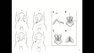 Urinary Diversion after radical cystectomy [upl. by Swetlana]