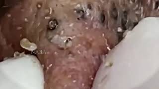 blackheads new 2023 today  blackheads  blackheads new2024 this week blackheads removal [upl. by Nagol]