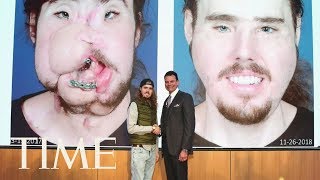 A Face Transplant Gave This 26YearOld A ‘Second Chance At Life’  TIME [upl. by Chandra959]