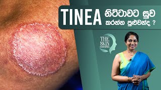 ඔබේ සමටත් දිලීර රෝගයක් Ringworm බෝවෙලාද  Dr Nayani Madarasinghe [upl. by Friederike]