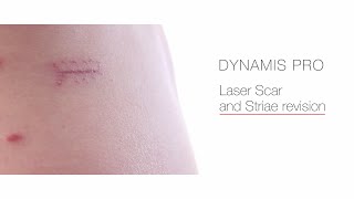 Laser Scar and Striae Revision [upl. by Everrs587]