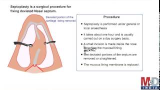 Septoplasty [upl. by Katy]