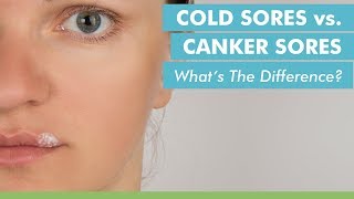 Cold Sores vs Canker Sores Whats The Difference [upl. by Tamberg]