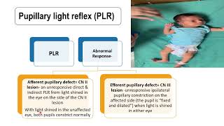 Pupillary Light Reflex  Pediatrics [upl. by Eyeleen]