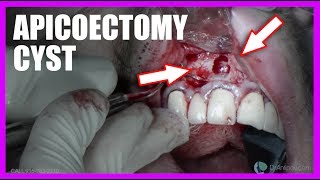 Apicoectomy Cyst SURGERY [upl. by Persis]