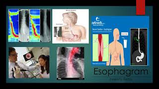 GabrielAvina 3MT Esophagram [upl. by Suoivatra566]