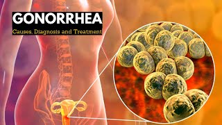 Gonorrhea Causes Signs and Symptoms Diagnosis and Treatment [upl. by Anoy733]