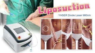 The new YASER 980nm diode laser tightens lifts and reduces fat during treatmentTRIANGEL YASER [upl. by Sasha]