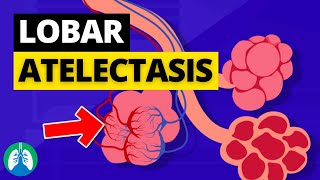 Lobar Atelectasis Medical Definition  Quick Explainer Video [upl. by Jacoba944]