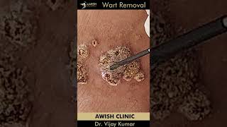 Wart removal treatment  Remove wart permanent  No pain wart remove awishclinic shorts drvijay [upl. by Anelrihs]