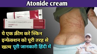 Atonide cream 005 use dose benefits and side effects full review in hindidesonide cream [upl. by Irelav]