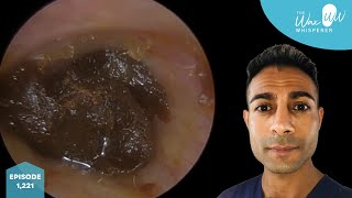 1221  Complete Ear Wax Blockage Removal [upl. by Nirrac]