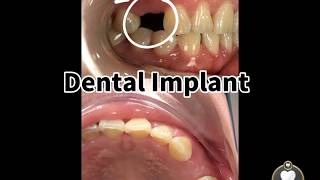 Dr Chloe Lim  Dental Implant [upl. by Oigile]