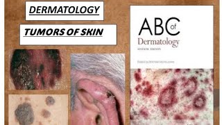 DERMATOLOGY TUMORS OF EPIDERMIS DERMIS amp MELANOCYTES PART2 benign amp malignant derma tumors [upl. by Collis559]