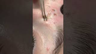 Blackheads Popping amp Blackhead Removal Videos 2022 [upl. by Oswald]