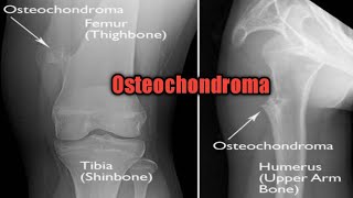 Osteochondroma  solitary and multiple pathology oncology cancer [upl. by Benioff]