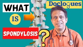 What is Spondylosis [upl. by Sekoorb]