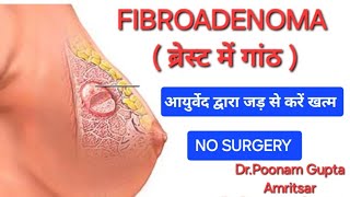 Dissolve Fibroadenoma ब्रेस्ट में गांठ without SurgeryAyurvedic Treatments drpoonamgupta [upl. by Nnywg]