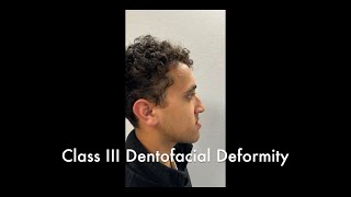 Bimaxillary Osteotomy and Genioplasty Part 1 [upl. by Elleinnad]